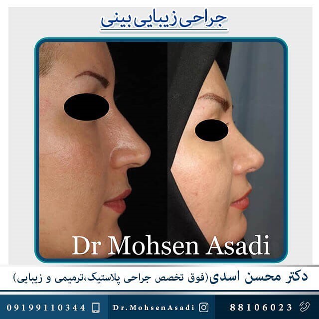جراحی بینی