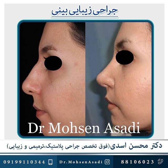 عمل بینی